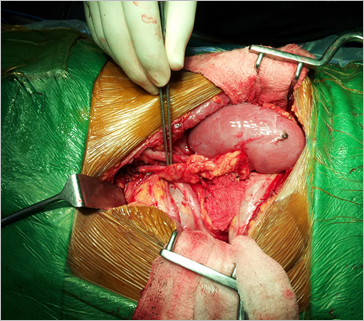 Kidney Transplant - Surgical Procedure