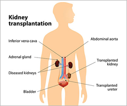 Kidney Transplant- Surgical Procedure
